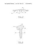 Wedge opening osteotomy plate diagram and image