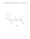 Systems and Methods for Remote Endarterectomy diagram and image