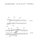 Systems and Methods for Remote Endarterectomy diagram and image