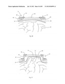 Decompressive Craniotomy Device and Methodology diagram and image