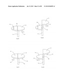 Decompressive Craniotomy Device and Methodology diagram and image