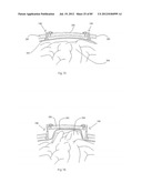 Decompressive Craniotomy Device and Methodology diagram and image