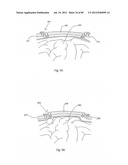 Decompressive Craniotomy Device and Methodology diagram and image