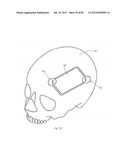 Decompressive Craniotomy Device and Methodology diagram and image