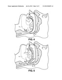 Jaw Thrust Appliance diagram and image