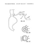 ASSEMBLY AND METHOD FOR AUTOMATICALLY CONTROLLING PRESSURE FOR A GASTRIC     BAND diagram and image