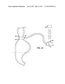 ASSEMBLY AND METHOD FOR AUTOMATICALLY CONTROLLING PRESSURE FOR A GASTRIC     BAND diagram and image