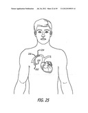 ASSEMBLY AND METHOD FOR AUTOMATICALLY CONTROLLING PRESSURE FOR A GASTRIC     BAND diagram and image