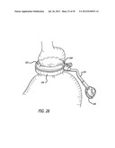 ASSEMBLY AND METHOD FOR AUTOMATICALLY CONTROLLING PRESSURE FOR A GASTRIC     BAND diagram and image