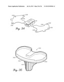 SENSORED PROSTHETIC COMPONENT AND METHOD diagram and image