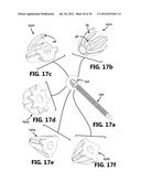 SYSTEMS, METHODS AND DEVICES FOR ACCURATE INFUSION OF FLUIDS diagram and image