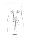 System and method for endoluminal and translumenal therapy diagram and image