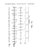 Apparatus and Methods for Titrating Arrhythmia Therapy Based on Spectral     Mapping During Sinus Rhythm diagram and image