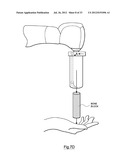 Bone Harvesting Device diagram and image