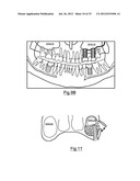 Bone Harvesting Device diagram and image