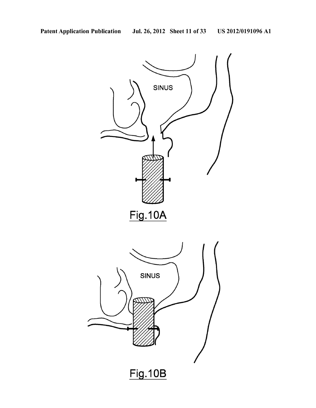 Bone Harvesting Device - diagram, schematic, and image 12