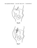 Bone Harvesting Device diagram and image