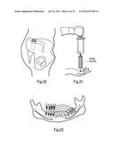 Bone Harvesting Device diagram and image