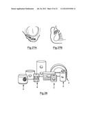 Bone Harvesting Device diagram and image