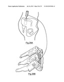 Bone Harvesting Device diagram and image