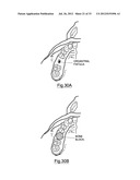 Bone Harvesting Device diagram and image