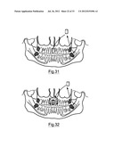 Bone Harvesting Device diagram and image