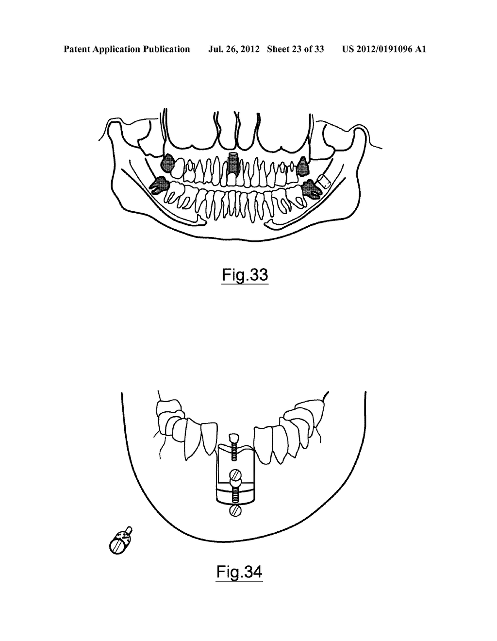 Bone Harvesting Device - diagram, schematic, and image 24