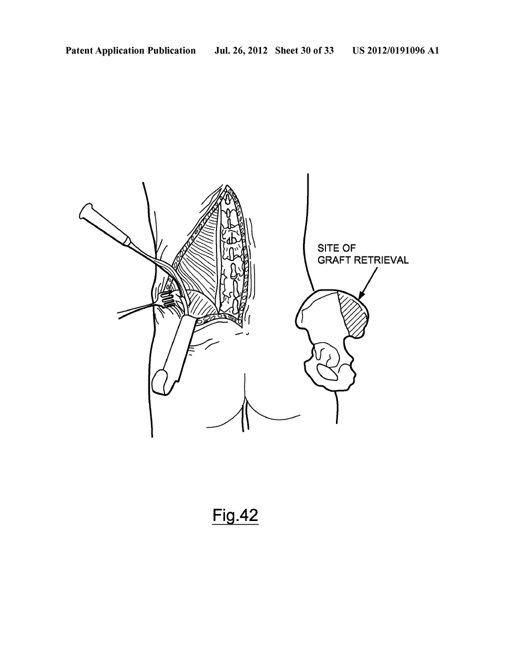 Bone Harvesting Device - diagram, schematic, and image 31