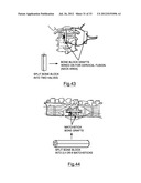 Bone Harvesting Device diagram and image