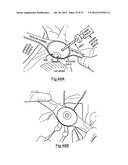 Bone Harvesting Device diagram and image