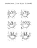 System and devices for the repair of a vertebral disc defect diagram and image