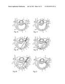 System and devices for the repair of a vertebral disc defect diagram and image