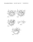 System and devices for the repair of a vertebral disc defect diagram and image