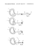 System and devices for the repair of a vertebral disc defect diagram and image