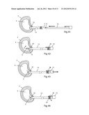 System and devices for the repair of a vertebral disc defect diagram and image