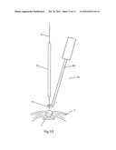 System and devices for the repair of a vertebral disc defect diagram and image