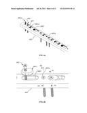 USE OF FLEXIBLE BUSHINGS TO PROMOTE HEALING AND STABLE FRACTURE     COMPRESSION IN ORTHOPEDIC TRAUMA PLATES diagram and image