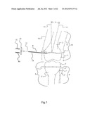 METHODS FOR BONE ALIGNMENT diagram and image