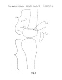 METHODS FOR BONE ALIGNMENT diagram and image