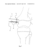 METHODS FOR BONE ALIGNMENT diagram and image