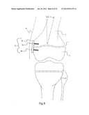 METHODS FOR BONE ALIGNMENT diagram and image