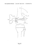 METHODS FOR BONE ALIGNMENT diagram and image