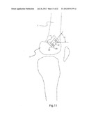 METHODS FOR BONE ALIGNMENT diagram and image