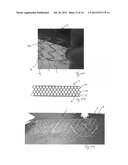 VASCULAR IMPLANTS AND METHODS diagram and image