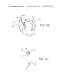 SYSTEMS AND METHODS FOR LOCALIZATION OF A PUNCTURE SITE RELATIVE TO A     MAMMALIAN TISSUE OF INTEREST diagram and image