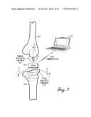 HERMETICALLY SEALED PROSTHETIC COMPONENT AND METHOD THEREFOR diagram and image