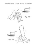 HERMETICALLY SEALED PROSTHETIC COMPONENT AND METHOD THEREFOR diagram and image