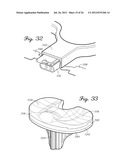 HERMETICALLY SEALED PROSTHETIC COMPONENT AND METHOD THEREFOR diagram and image