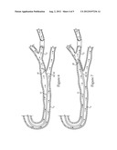 Catheter Assembly And Method diagram and image