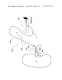 APPARATUSES FOR RENAL NEUROMODULATION diagram and image